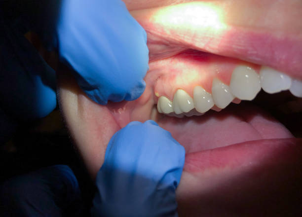 Best Root Canal Emergency Dentist  in Atwood, IL